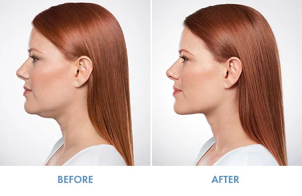 Kybella fat reduction by Believe Aesthetics in San Antonio , TX