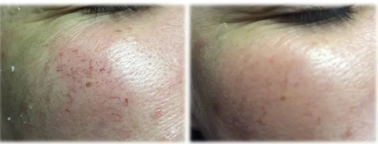 Laser vein removal by Believe Aesthetics in San Antonio , TX